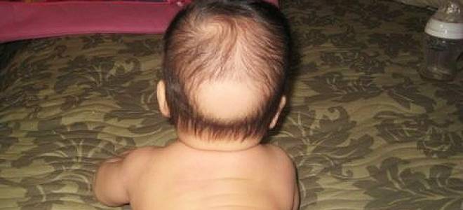 Выпадают волосы у ребенка 3 лет причины и лечение