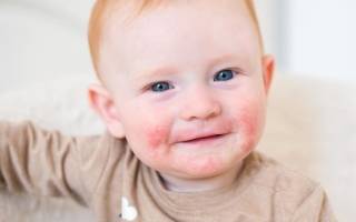 Как выглядит аллергический дерматит у детей?