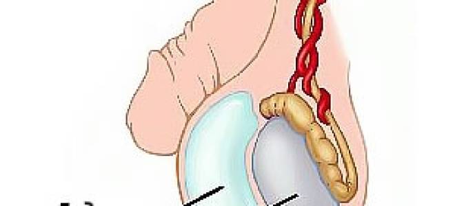 Водянка яичек у новорожденных мальчиков