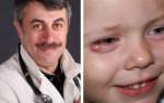 Ячмень на глазу у ребенка 2 года лечение комаровский