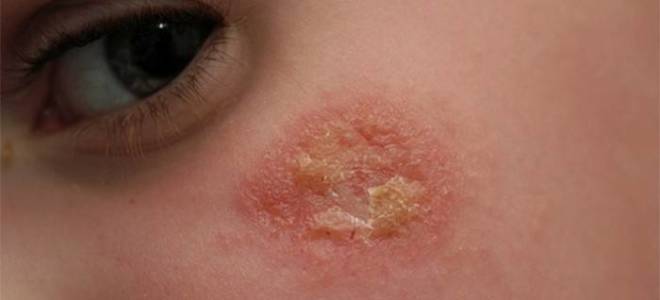 Острый отит у ребенка лечение в домашних условиях