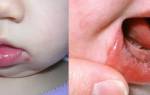 Герпес во рту у ребенка 3 года лечение
