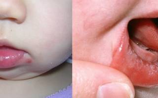 Герпес во рту у ребенка 3 года лечение