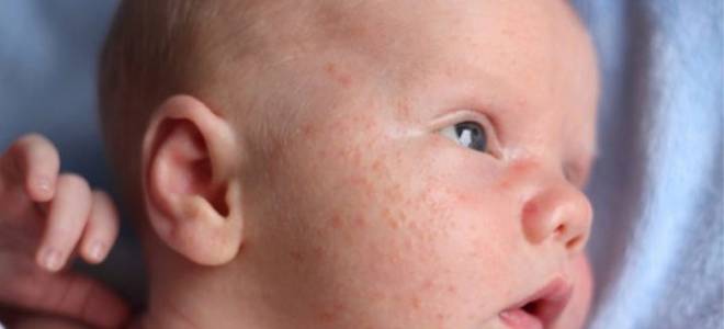 Как отличить потницу от аллергии у грудничка на лице?