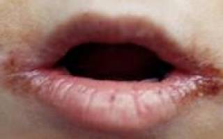 Простуда на губе у ребенка лечение в домашних условиях