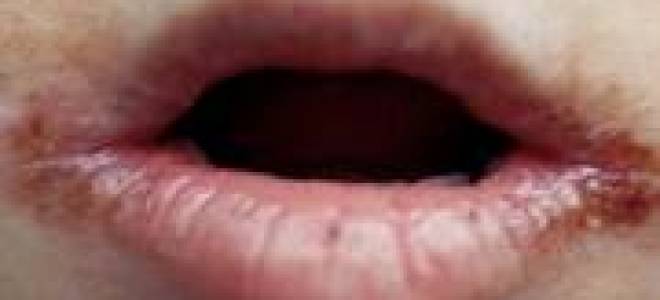 Простуда на губе у ребенка лечение в домашних условиях