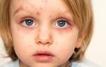 Вирус простого герпеса у ребенка симптомы и лечение