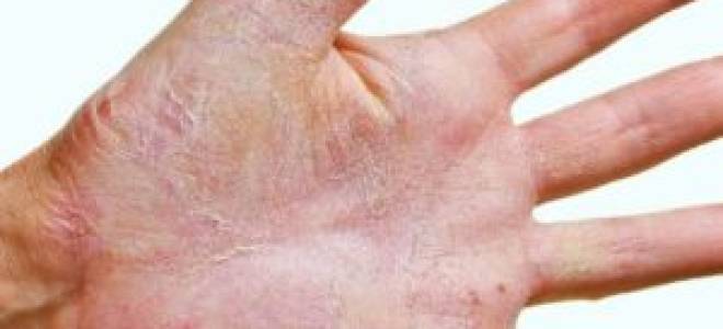 Грибок на ладонях у ребенка 3х лет лечение