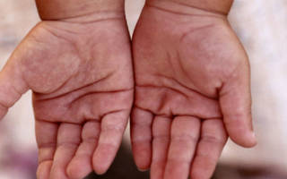 Аллергия на ладошках мягких местах у ребенка лечение