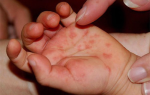 Энтеровирусные инфекции у детей. Чем лечат и как их диагностируют?