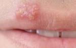 Простуда на губе у ребенка лечение в домашних условиях