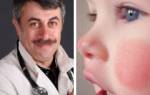 Красные щеки у ребенка 10 месяцев причины и лечение