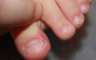 Вросший ноготь на большом пальце у ребенка лечение