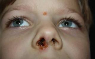 Герпес в носу у ребенка симптомы и лечение