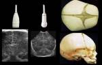 Расширенные сосуды головного мозга у грудного ребенка лечение