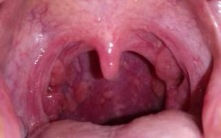 Папиллома в горле у ребенка причины и лечение