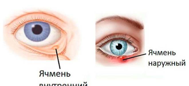 Лечение ячменя на глазу у ребенка в домашних условиях