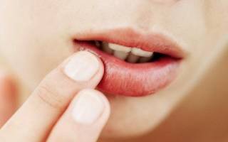 Раздражение вокруг рта у ребенка лечение народными средствами