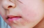 Покраснение вокруг губ у ребенка причины и лечение
