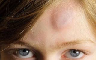 Шишка на голове от удара лечение у ребенка