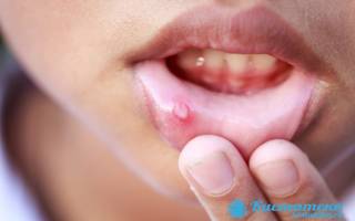 Ретенционная киста нижней губы лечение без операции у ребенка