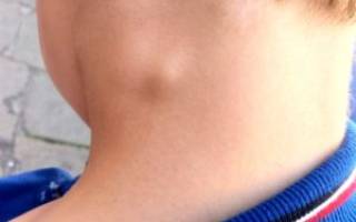 Лечение увеличены лимфоузлы на шее у ребенка причины лечение