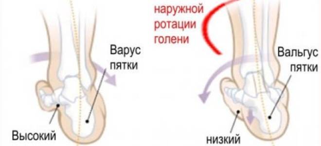 Вальгусная деформация стопы у ребенка 10 лет лечение