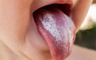 Белый налет на языке у ребенка 3 года лечение