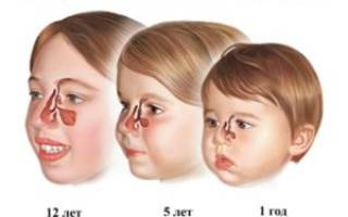 Гайморит у ребенка 3 лет симптомы и лечение