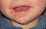 Лечение герпеса на губах у ребенка 3 лет