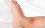 Красные пятна на ногах у ребенка чешутся лечение