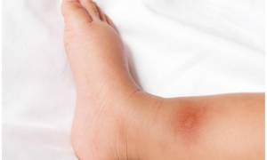 На ногах у ребенка появились красные пятна и чешутся лечение