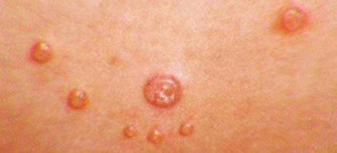 Моллюски на коже у ребенка лечение народными средствами