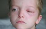 Припухлость верхнего века глаза у ребенка причины и лечение
