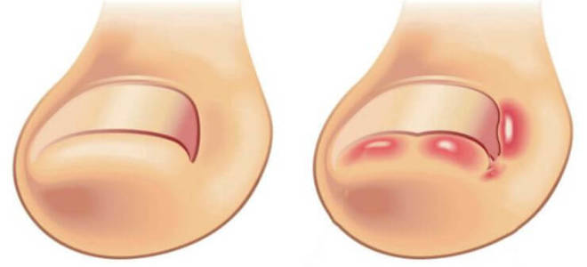 Вросший ноготь на большом пальце у ребенка лечение народными средствами