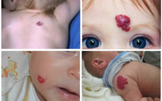 Пигментные пятна на лице причины и лечение у ребенка