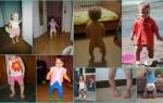 О образное искривление ног у ребенка 1 год лечение