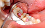 Сколько у ребенка при лечении в зубе находится должно лекарство