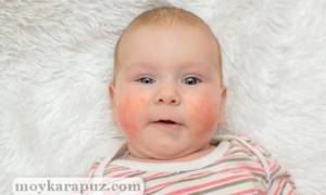У ребенка щеки красные и шершавые причины лечение
