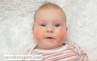 У ребенка щеки красные и шершавые причины лечение