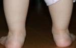 Натоптыши на ступнях у ребенка 8 лет лечение