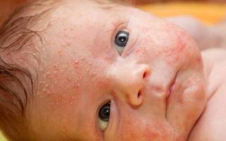 Сыпь у новорожденного ребенка по всему телу лечение