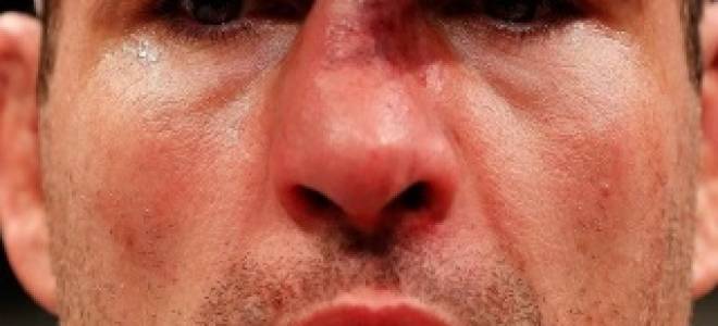 Перелом носа без смещения лечение у ребенка препараты