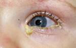 Гной из глаза у ребенка 2 года лечение
